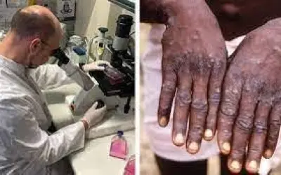 मंकीपॉक्स के खतरे को देखते हुए केंद्र सरकार ने राज्यों को किया अलर्ट