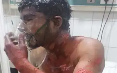 प्रेमिका ने प्रेमी को तेजाब से नहलाया, झुलसकर हुई मौत